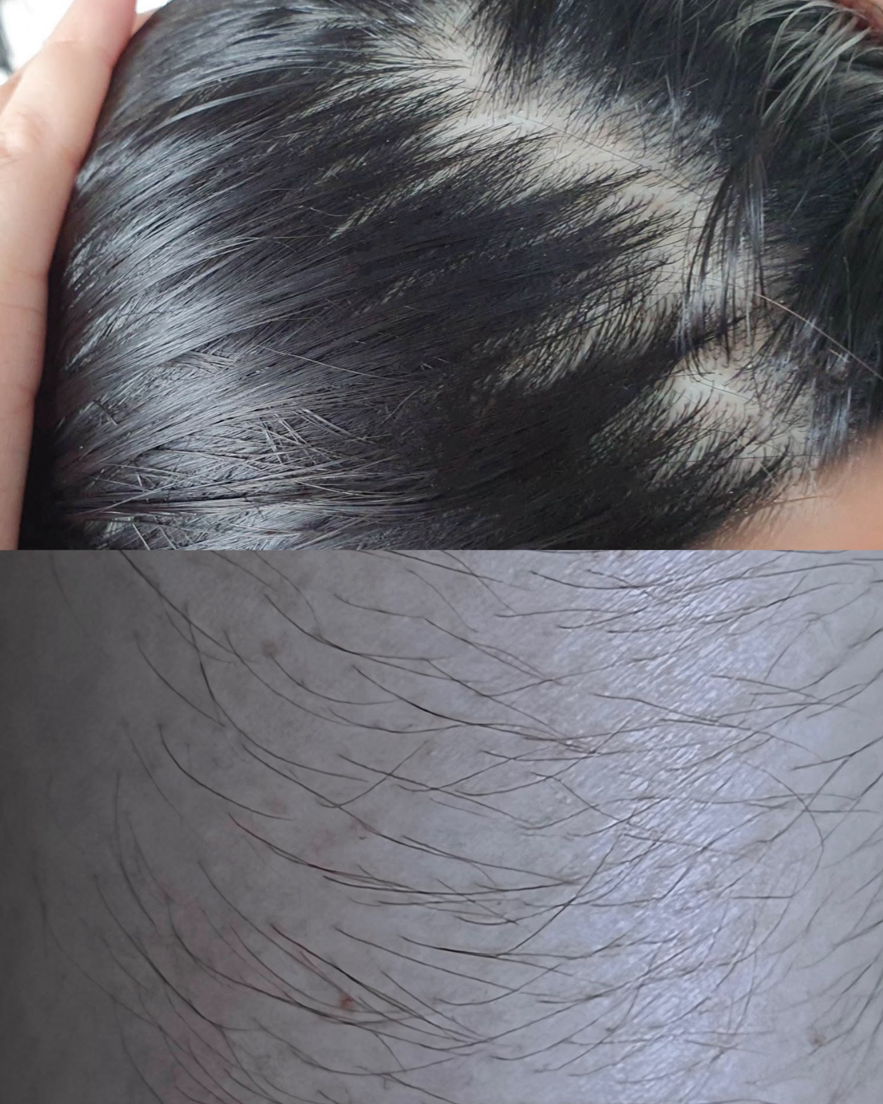 Hairfall & Hirsutism ➝ Balanced Hair Growth - Before