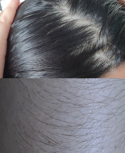 Hairfall & Hirsutism ➝ Balanced Hair Growth - Before