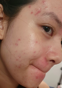 Acne → Clear Skin - Before